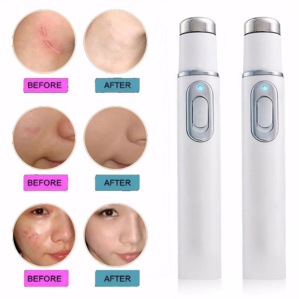 Caneta aquecida para terapia d - Acne Light Therapy Pen avaliação e preço