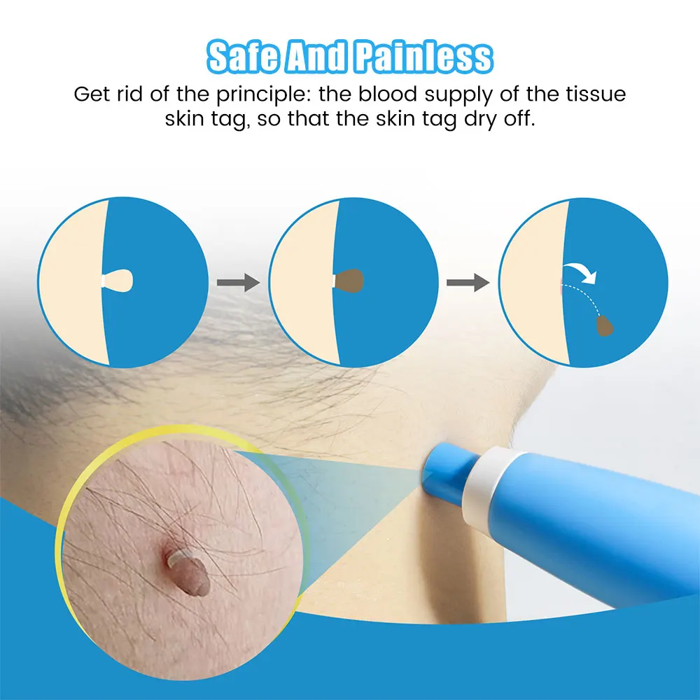 Kit de ferramentas para remoçã - Acne Light Therapy Pen avaliação e preço