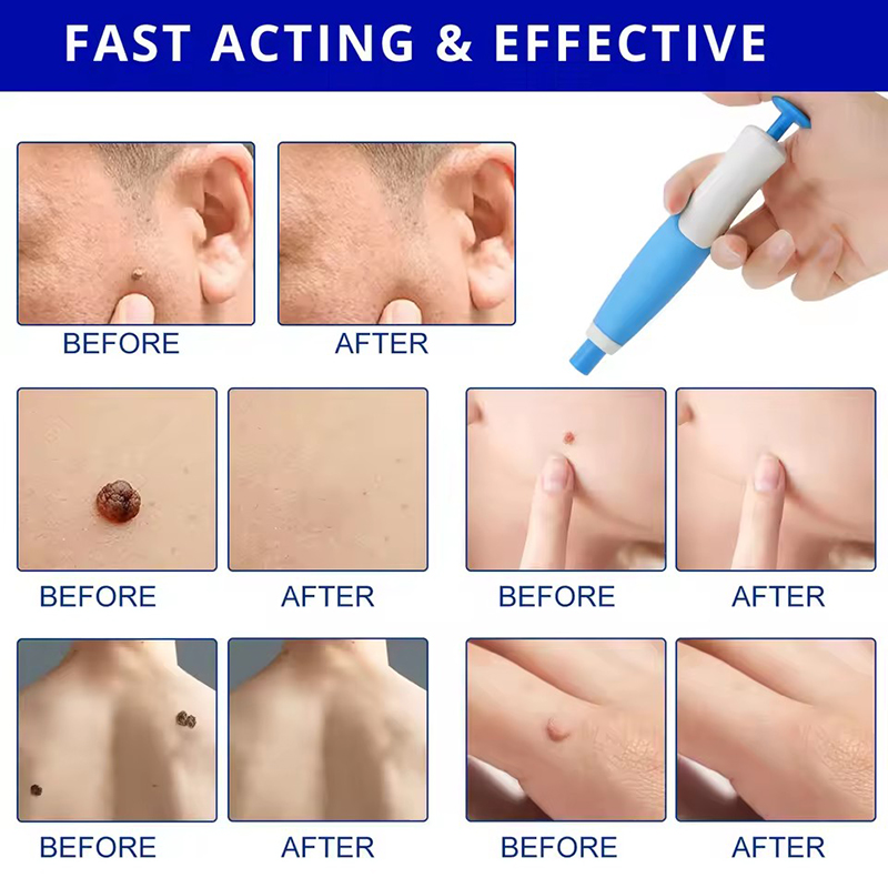Kit 2 em 1 para Remoção de Ver - Acne Light Therapy Pen avaliação e preço