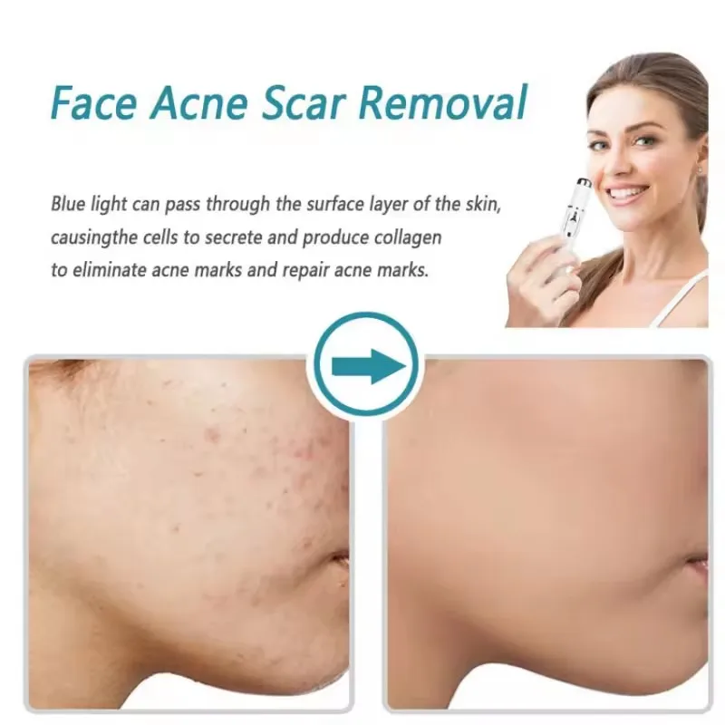 Caneta de terapia de luz azul  - Acne Light Therapy Pen avaliação e preço