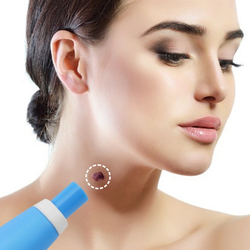 Kit Removedor de Verrugas para - Acne Light Therapy Pen avaliação e preço
